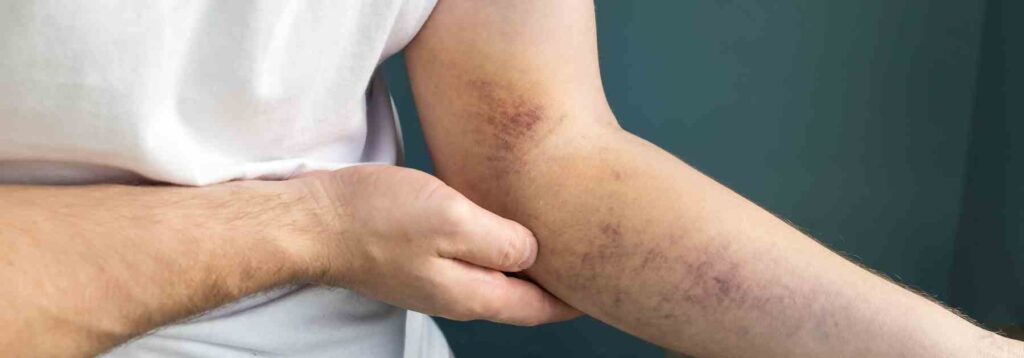 Where to inject Mounjaro for weight loss. 