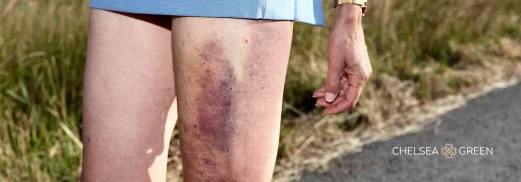 Bruised thigh