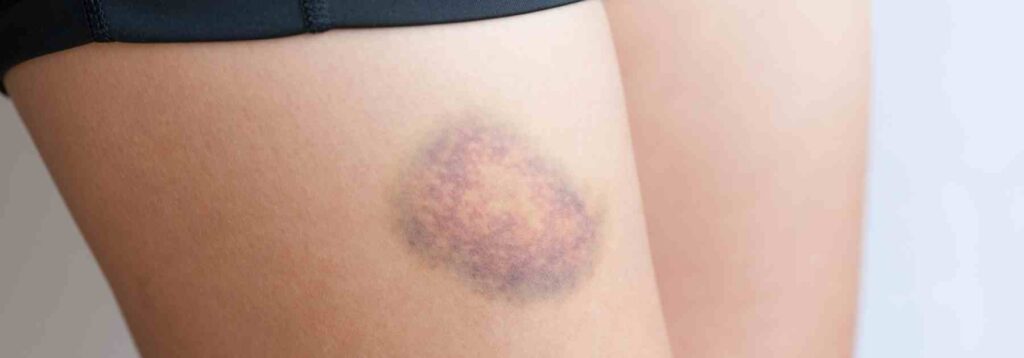Anaemia rash and bruising - get a blood test!