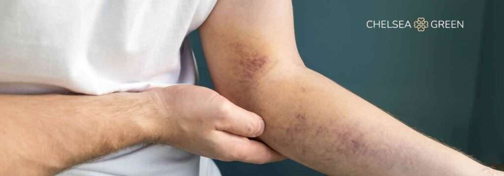 Bruised arm from weight loss injections