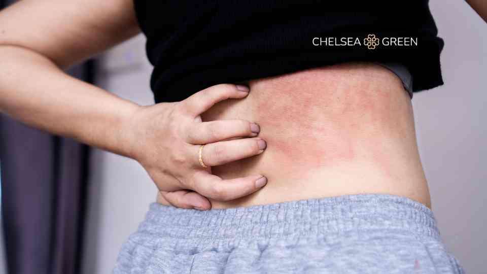 Rash on back