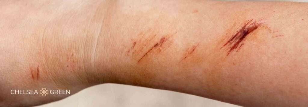 Rare side effects of the rabies vaccine