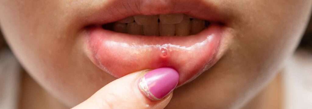 Mouth ulcer on a woman's lip
