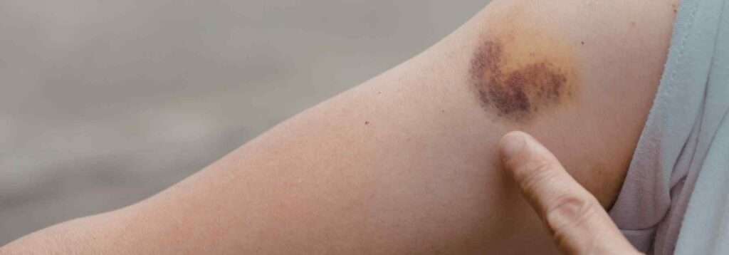 Bruise on arm due to weight loss injections