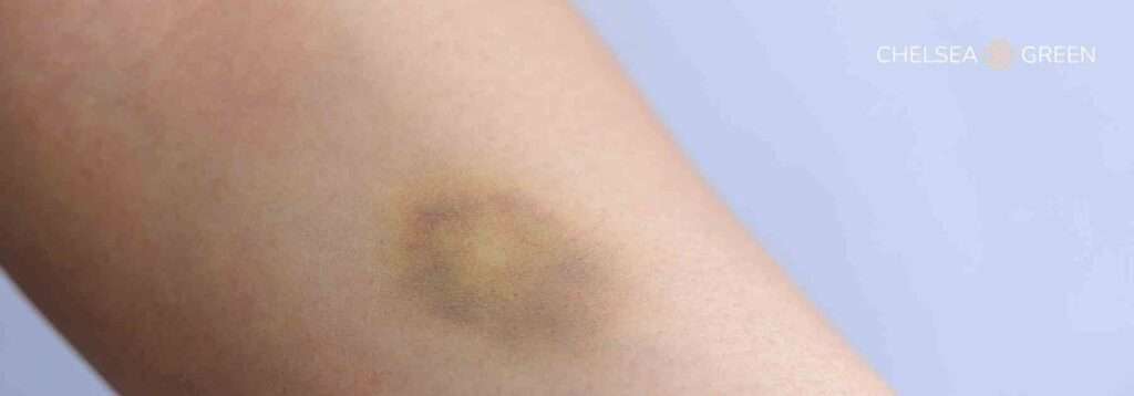 Bruised arm from using Mounjaro