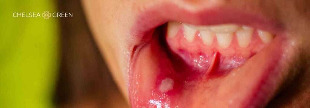 Lip ulcer on a woman's inner bottom lip